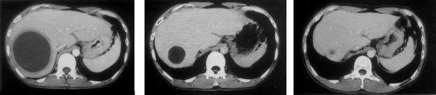 赤痢アメーバ性肝膿瘍の治療によるCT像の変化の画像